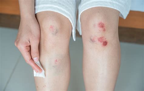 Bruise Vs Blood Clot: जानिए ब्रूस या ब्लड क्लॉट से जुड़ी महत्वपूर्ण ...
