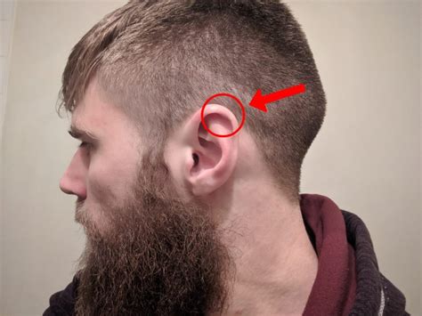 Kuvatulokset haulle cauliflower ear
