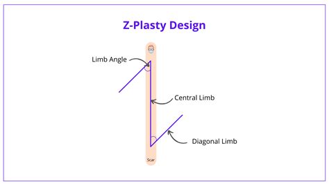 Z-Plasty: Designs, Indications, Variations and Complications