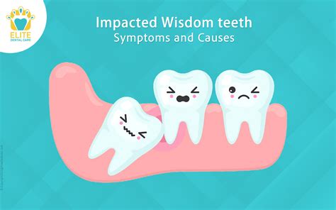 Image result for Wisdom Teeth Impaction Types
