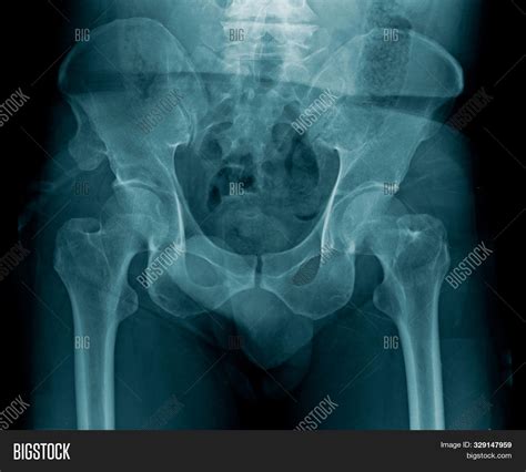 Pelvic Bone X Ray