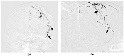 Penetration of Non-Adhesive Gel-like Embolic Materials During Dural ...