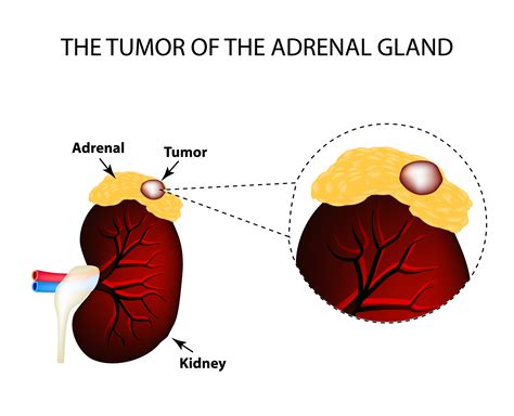 What Is Adrenal Gland Cancer Symptoms at Joseph Russo blog