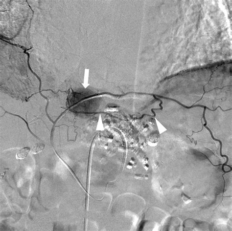 Chemoembolization of the Left Inferior Phrenic Artery in Patients With Hepatocellular Carcinoma ...