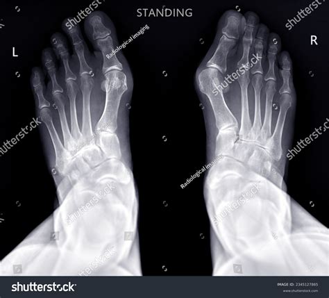 X Ray Broken Toe Toe Fracture | Radiology Case | Radiopaedia.org