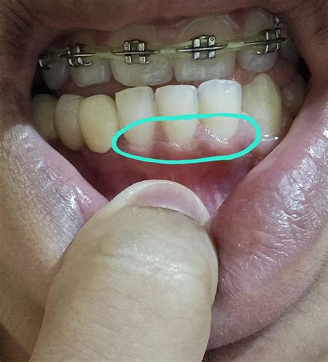 Gums feeling like they are coming outwards after flossing. : r/askdentists