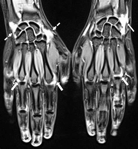 Does Mri Of Hand Include Fingers at Susie Branch blog