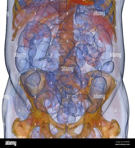 3D CT scan image of a CT colonography procedure Stock Photo - Alamy