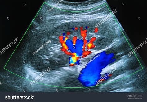 What Does It Mean When You See Red On An Ultrasound at Tamara Hall blog