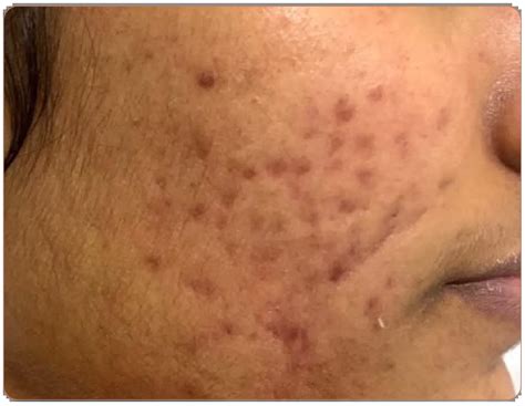 Kolors Hair and Skin - Pimples Treatment Images