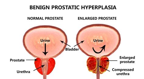 Understanding an Enlarged Prostate: Symptoms, Causes, and Treatment Options - Gmoney.in