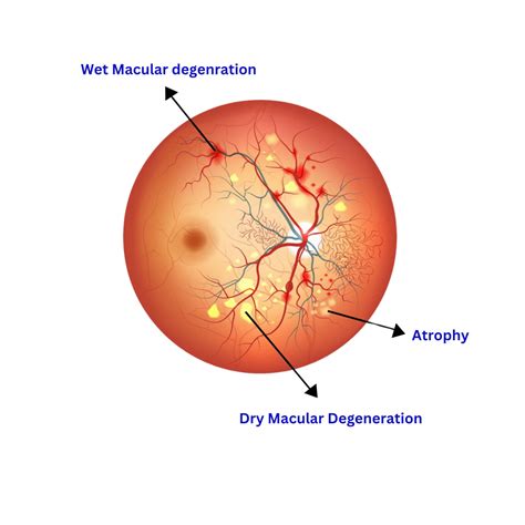 ARMD : Understanding Age-Related Macular Degeneration