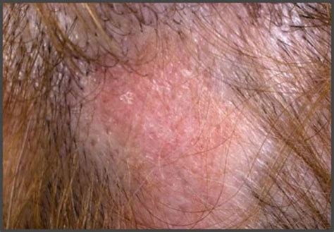 Pictures of shingles on the scalp | Shingles Expert