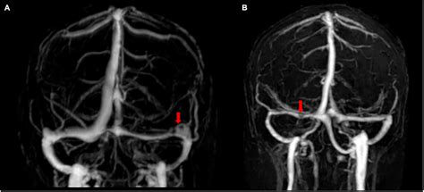 Frontiers | Anatomy imaging and hemodynamics research on the cerebral ...