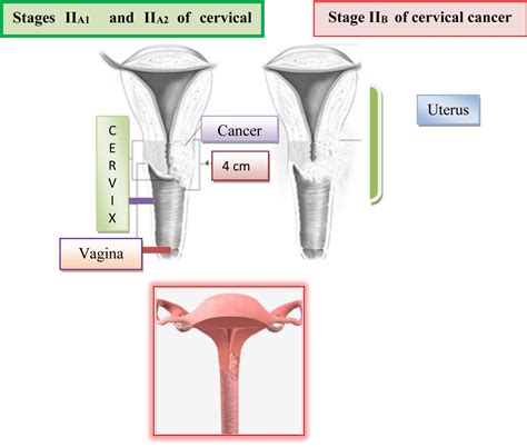 Cervical Cancer Stage 1