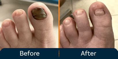 Full Toenail Extraction 的图像结果