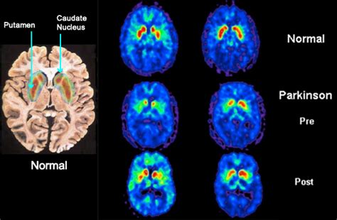 Image result for Dat Scan Lewy Body