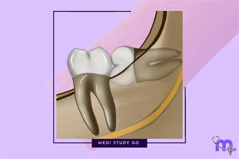Dental Impaction: A Comprehensive Guide for Dental Professionals – Medi ...