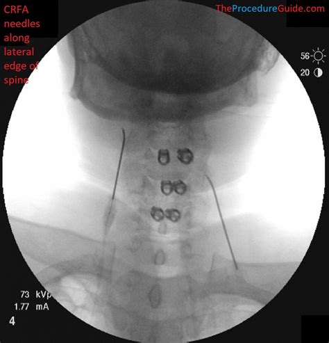 Image result for Fluoro Spinal Injection