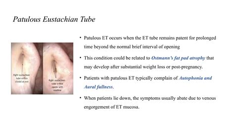 Eustachian Tube - Anatomy physiology and Disorders UG.pptx