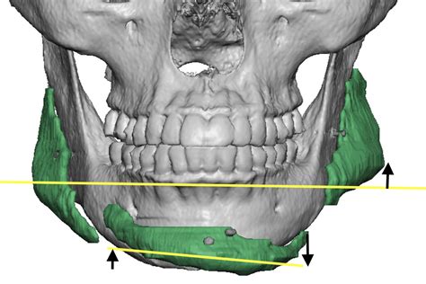 Plastic Surgery Case Study - Custom Jawline Implant Replacement of Standard Chin and Jaw Angle ...