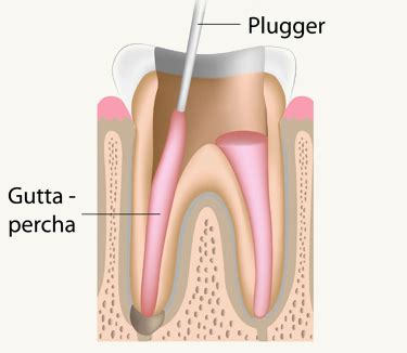 Root Canal Treatment – Dr. Pillai's Sacred Heart Dental Clinic in Mumbai