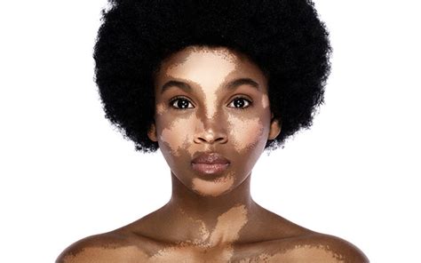 How To Treat Hypopigmentation With Ayurveda? – Vedix