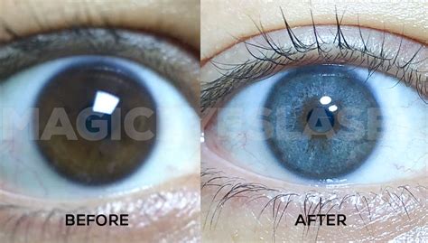 Image result for Eye Color Change Procedure