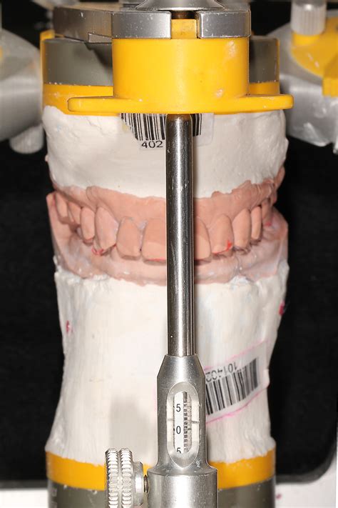 CAD/CAM: Applications for transitional bonding to restore occlusal ...