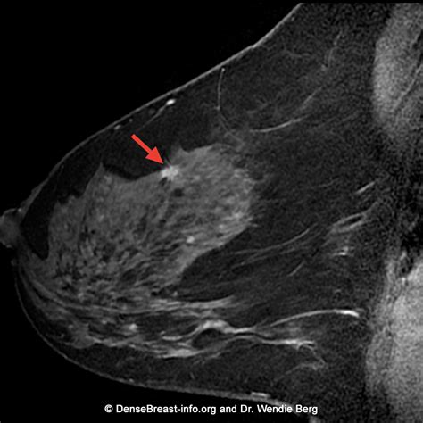 Breast MRI | DenseBreast-info, Inc.