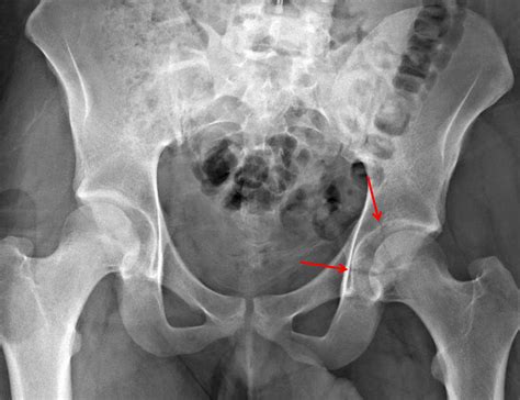 What Is A Posterior Wall Acetabular Fracture at Eva Dolling blog
