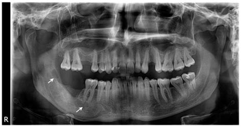 Various Surgical Interventions in Treating Odontogenic Keratocyst: A ...