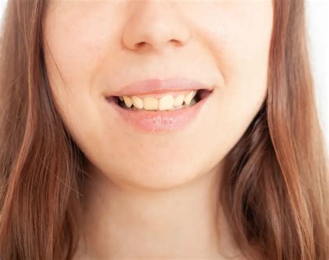 Image result for Teeth Staining Causes