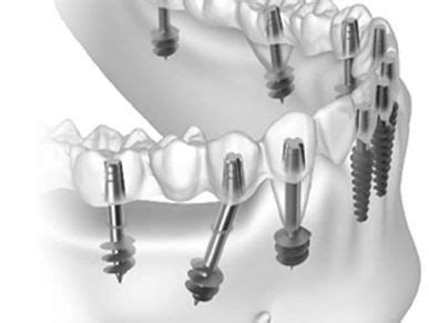 Dental Implants | EndoMax Multi-speciality Dental Clinic