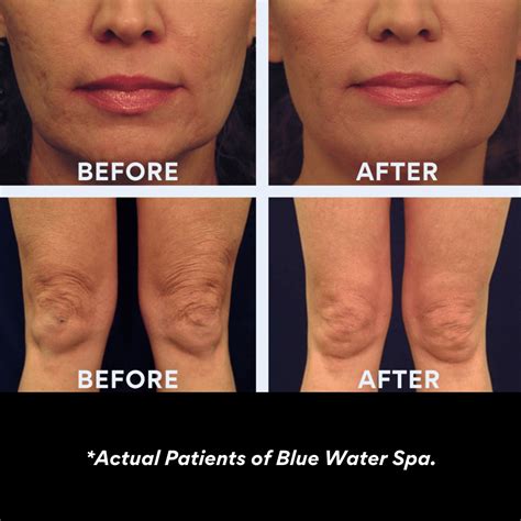 Laser Tightening Skin _ Laser Skin Tightening Decolletage – GWGK