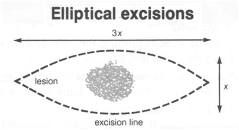 Image result for Mutilation Excision