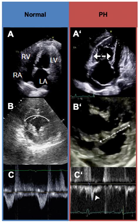 Diagnostic Evaluation of Pulmonary Hypertension: A Comprehensive Approach for Primary Care ...