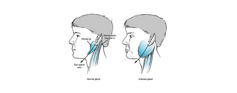Leech Therapy: Procedure And Its Benefits | Birla Ayurveda