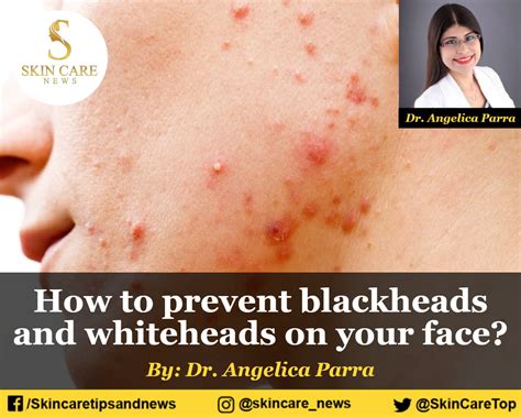 How to prevent blackheads and whiteheads on your face? - how to prevent blackheads