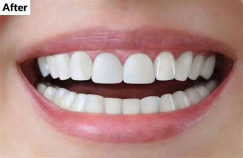 Chisel Dental Clinic | Dentist | Bangalore | Koramangala | Best ...