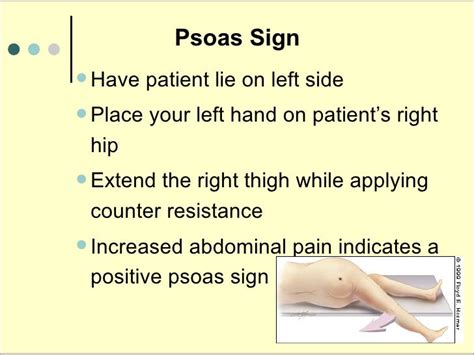Image result for Psoas Sign