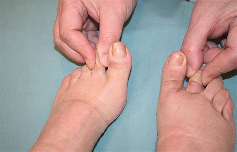 Der Behandlungspfad beim Lymphödem - Dermatologie - Universimed ...