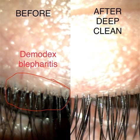 Myopia Treatment Center on LinkedIn: #blepharitis #mites #demodex # ...