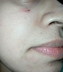 WARTOSIN (3ML) Wart and Skin Tags Removal Herbal and Ayurvedic Solution ...