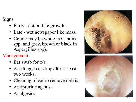 Otitis externa on human ear Pathophysiology | PPTX