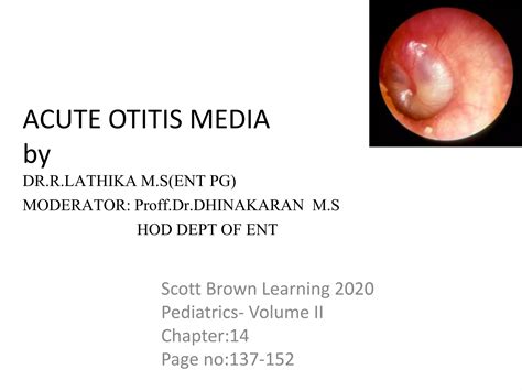 Acute otitis media final | PPTX