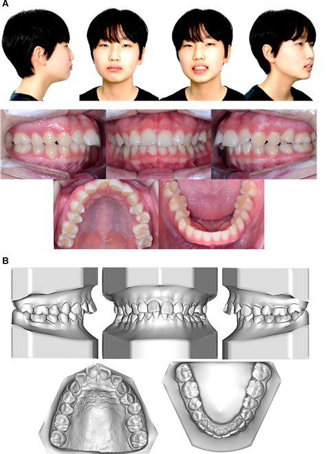 Orthodontic treatment of an open bite after splint therapy for a patient with idiopathic ...