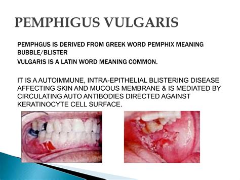 Pemphigus and Pemphigoid | PPTX