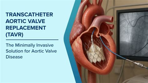 TAVR Heart Valve Replacement: Benefits, Risks & Recovery | Max Hospital
