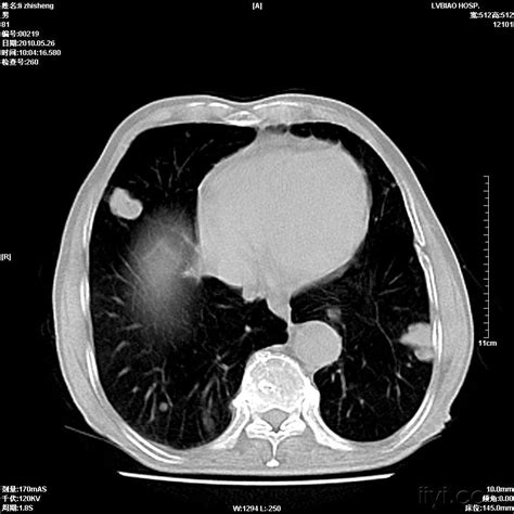 正常肺图片ct,正常肺t片图片区分,正常t肺图片大全_大山谷图库